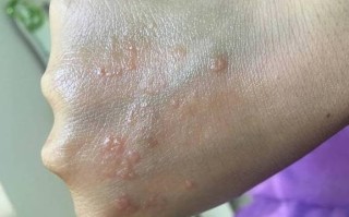 手上突然长出成群的“小水泡”，还很痒？