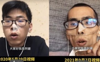 患癌症后骨瘦如柴?该吃哪些食物?不能吃哪些食物? 患癌症后骨瘦如柴?该吃哪些食物?不能吃哪些食物?